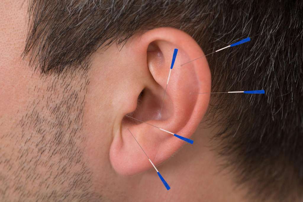 Acupuntura