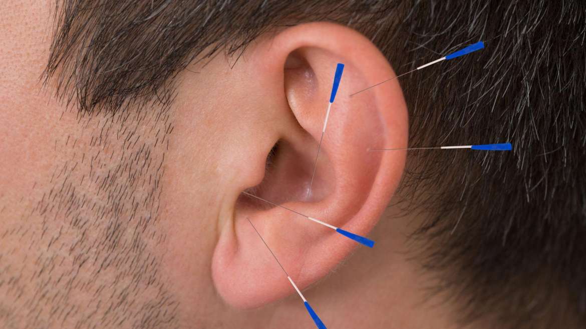 Acupuntura en Otorrinolaringología